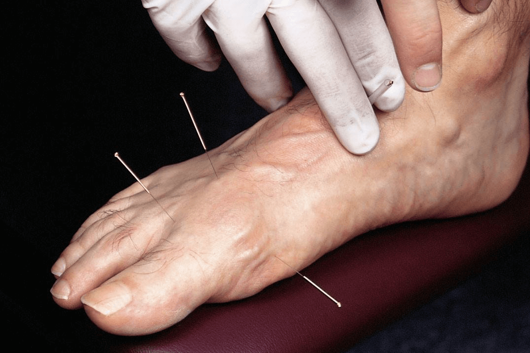 Podiatric Acupuncture - foot acupuncture - male foot