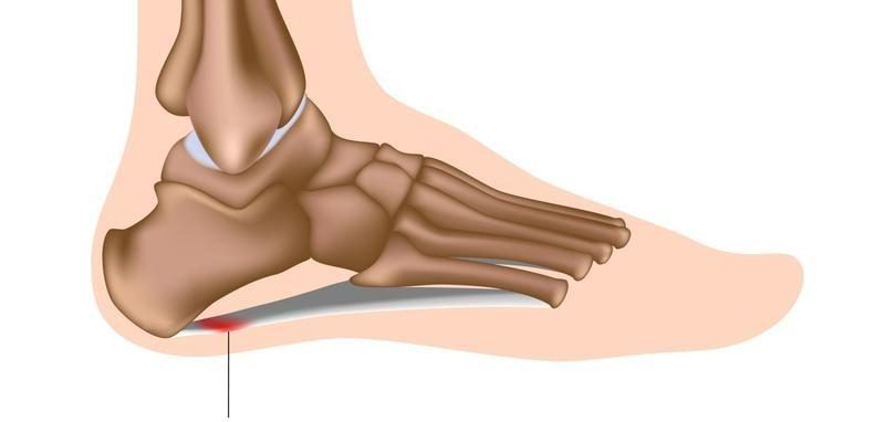 Inflammation of Plantar Fasciitis in ankle